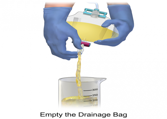Portable PVC Disposable Foley Catheter Bag Non Toxic For ICU Urine Collection