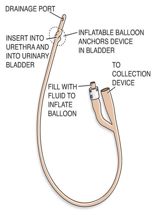 Pediatric Antibacterial Disposable Urinary Catheters 2 Way 50ml With Rubber Color Valve