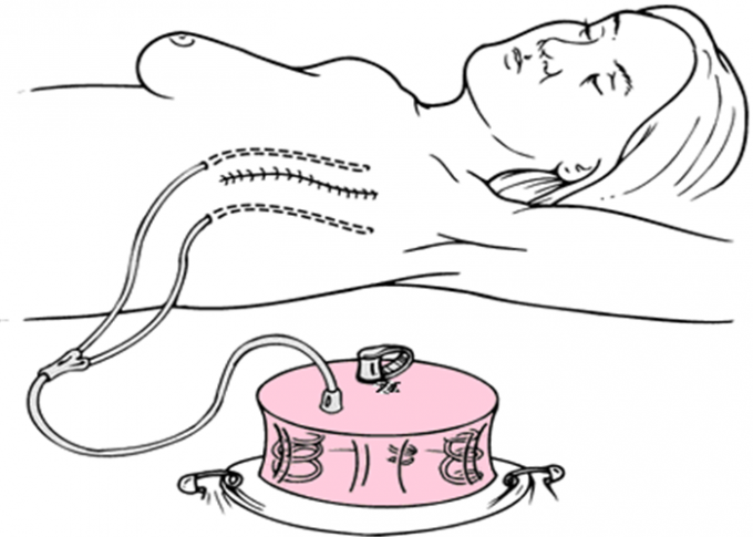 Anti - Leakage 800ml Disposable Abdominal Drainage Tube With 3 Activated Springs