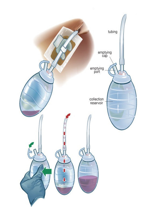 Convenient Closed Wound Suction Drainage System Single Use Only For Body Drain Removal